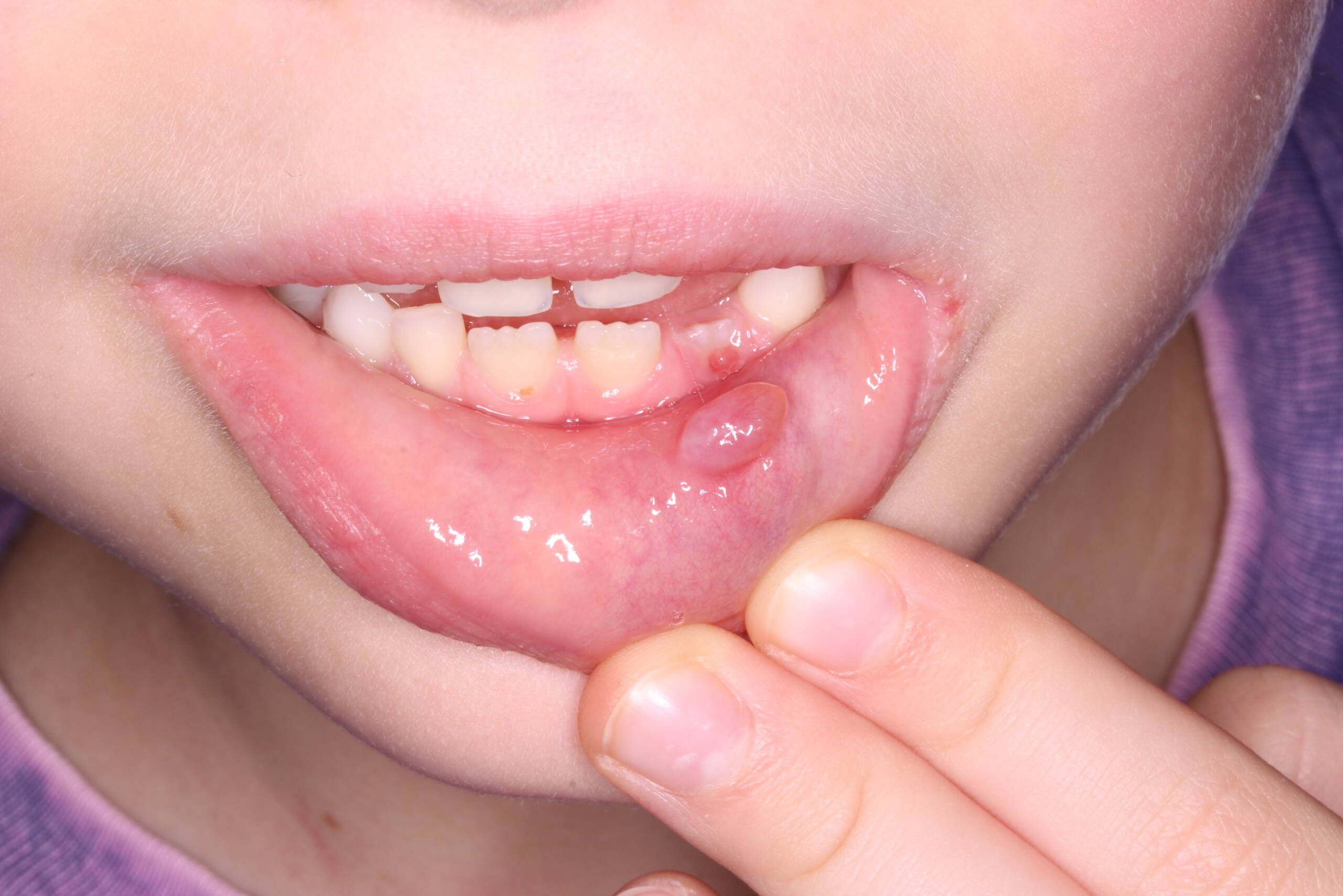 Mucocele labial