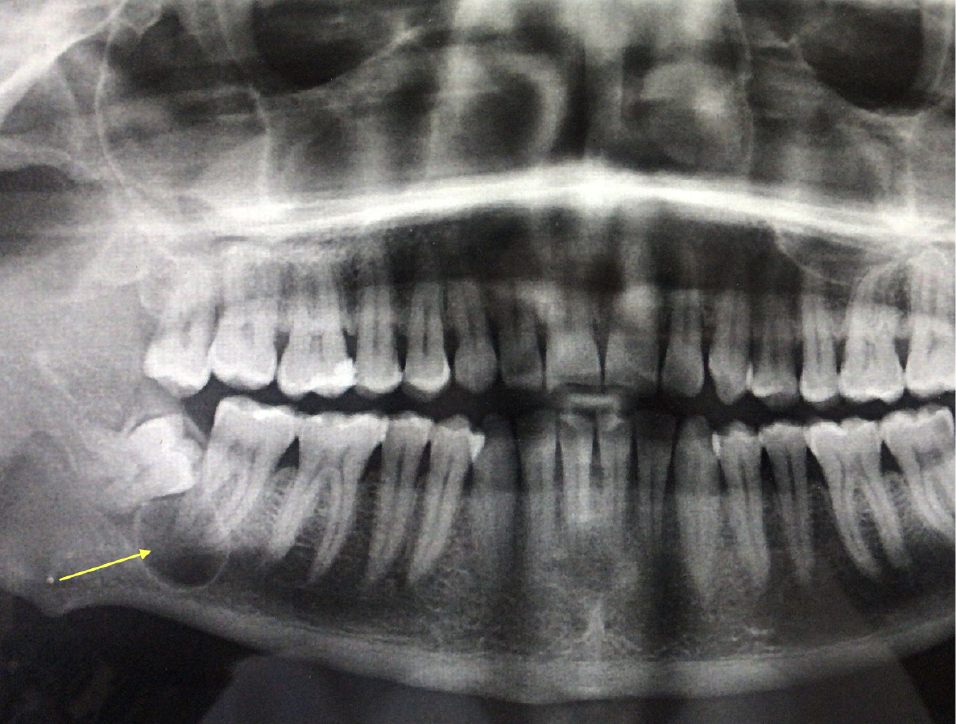 Cirugía Oral e Implantes